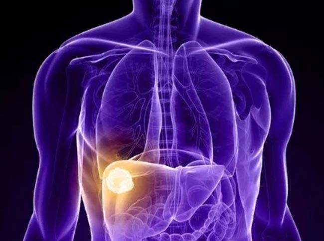 肝细胞性肝癌