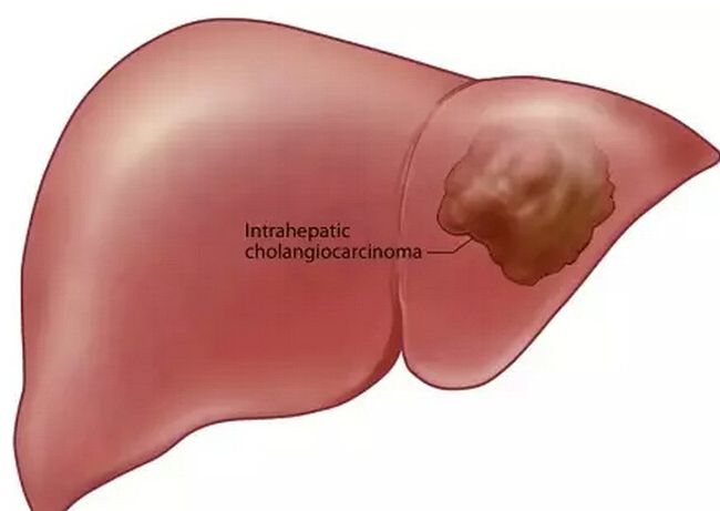 肝内胆管细胞癌